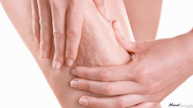 Cellulite: Metabolische Wahrheit - BlauBahn