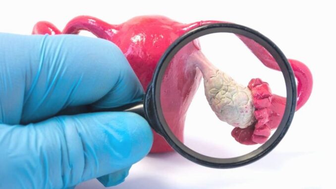 Das verborgene Problem einer von zehn Frauen: Was ist Endometriose? - BlauBahn