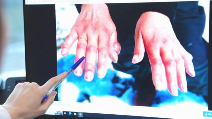 Gefahr bei kaltem Wetter: Erfrierungen können zum Fingerverlust führen! - BlauBahn