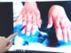 Gefahr bei kaltem Wetter: Erfrierungen können zum Fingerverlust führen! - BlauBahn
