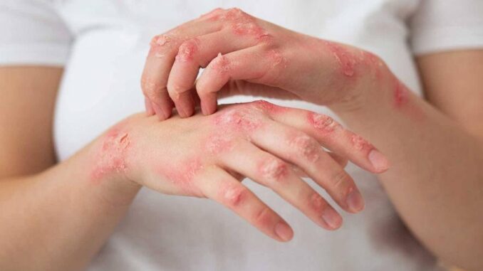 Auswirkungen von Psoriasis auf die Herzgesundheit - BlauBahn