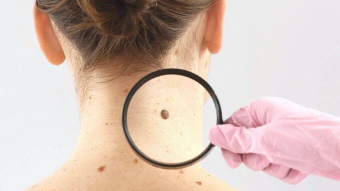 Dermatologischer Warnhinweis: Wichtige Veränderungen an Ihrer Haut ernst nehmen - BlauBahn