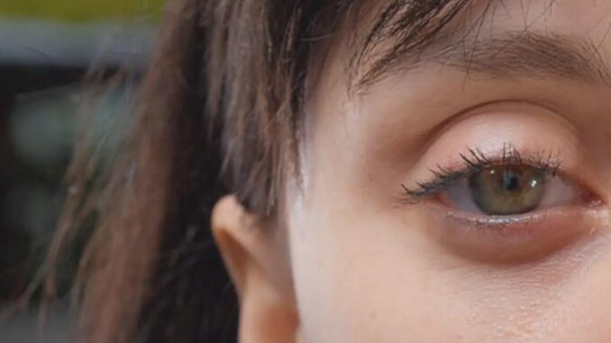 Mögliche Anzeichen von Myasthenia Gravis: Schlupflid-Dystrophie - BlauBahn
